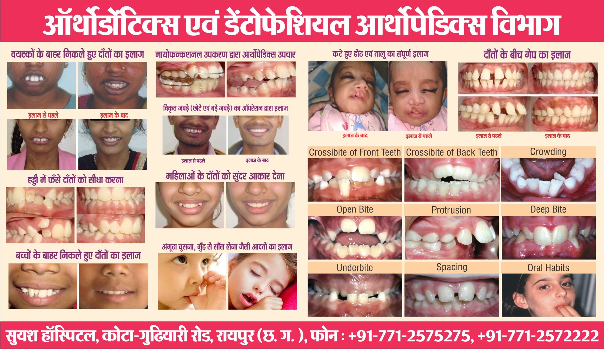 suyash orthodontics surgery 04