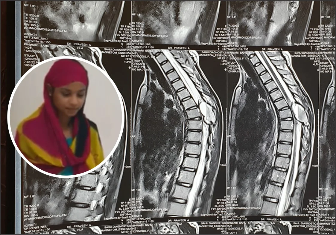 Successful neurosurgical treatment of paraplegia patient